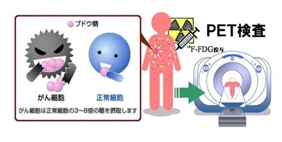 ｅｓ大豆発酵生産物と炭水化物と大腸がん